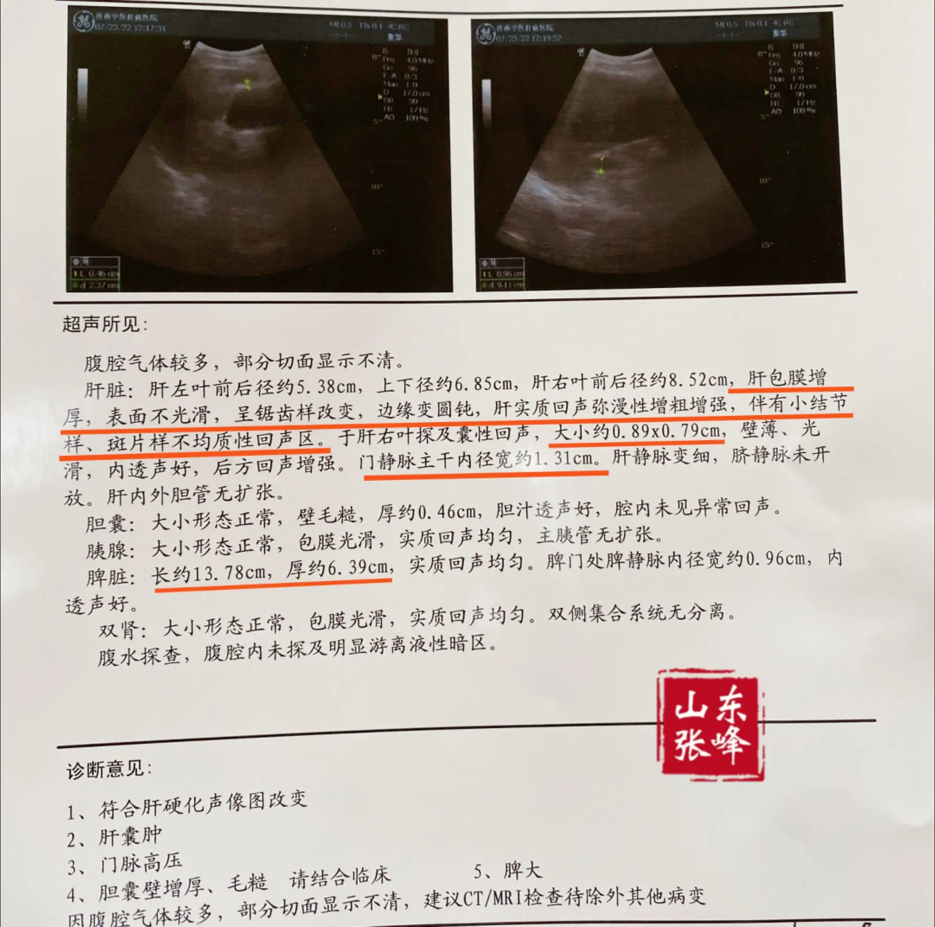 肝脏彩超一旦出现以下5点，你离肝硬化就不远了！1、脾脏增大，如果有肝病...