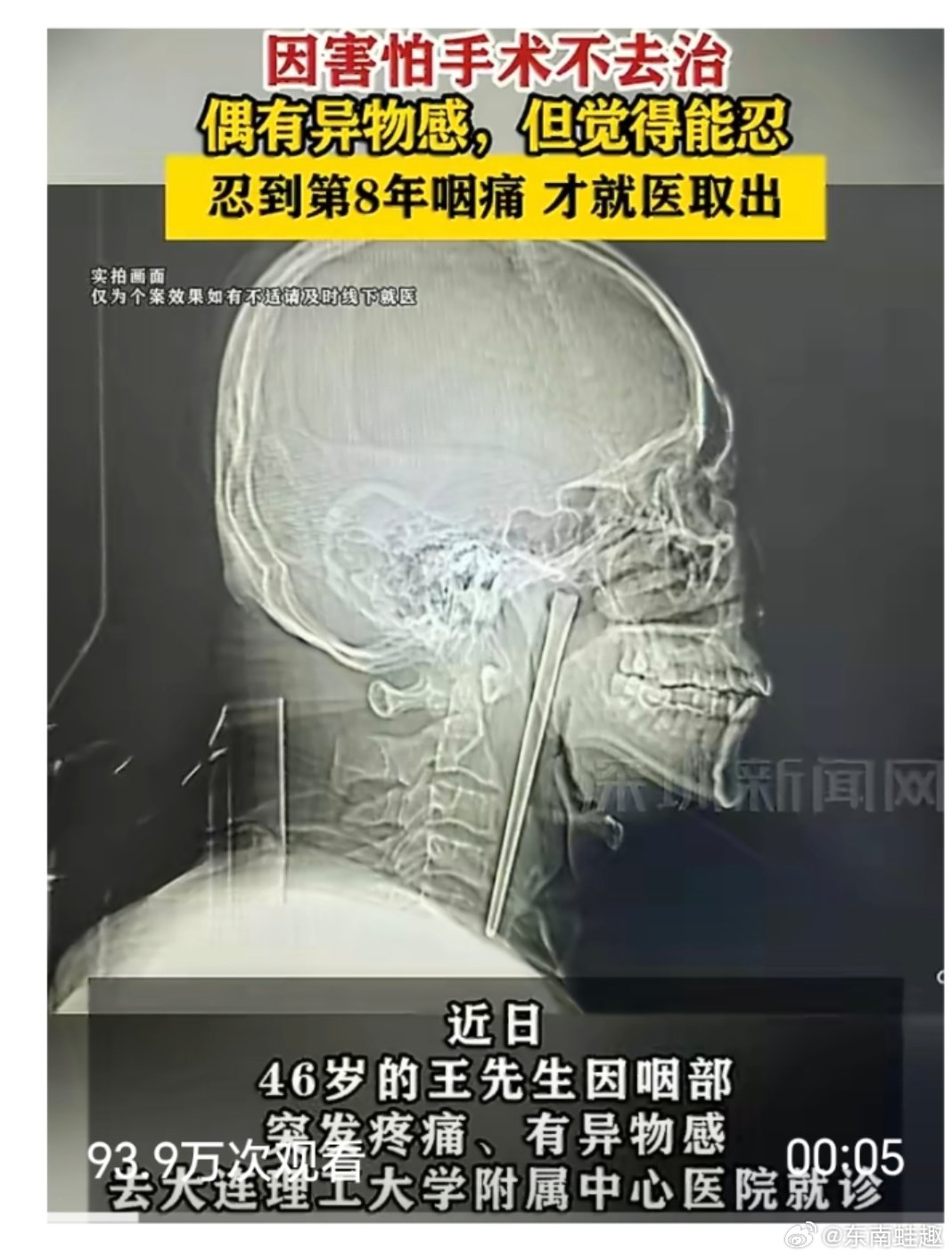男子误吞12厘米筷子忍了8年才取出这么长的筷子怎么能误吞下去的呢？ 