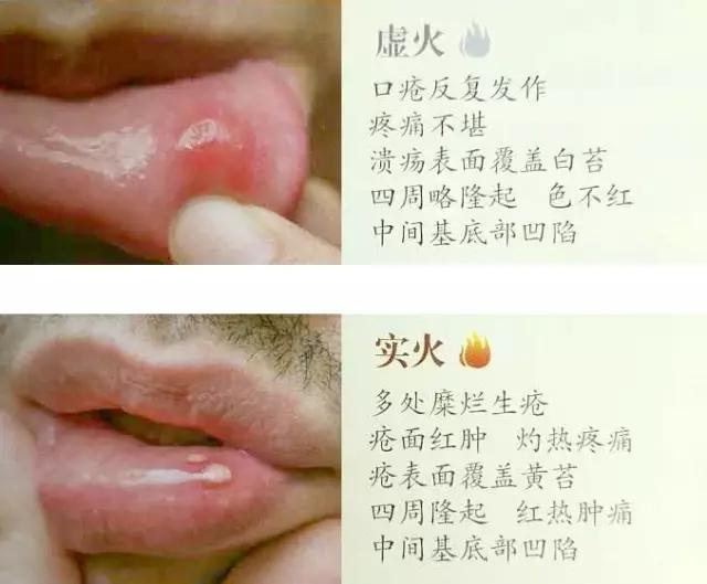 很多上火其实是虚火
夏天到了很多朋友开始吃姜了，但是有的朋友就说，我容易上火啊，