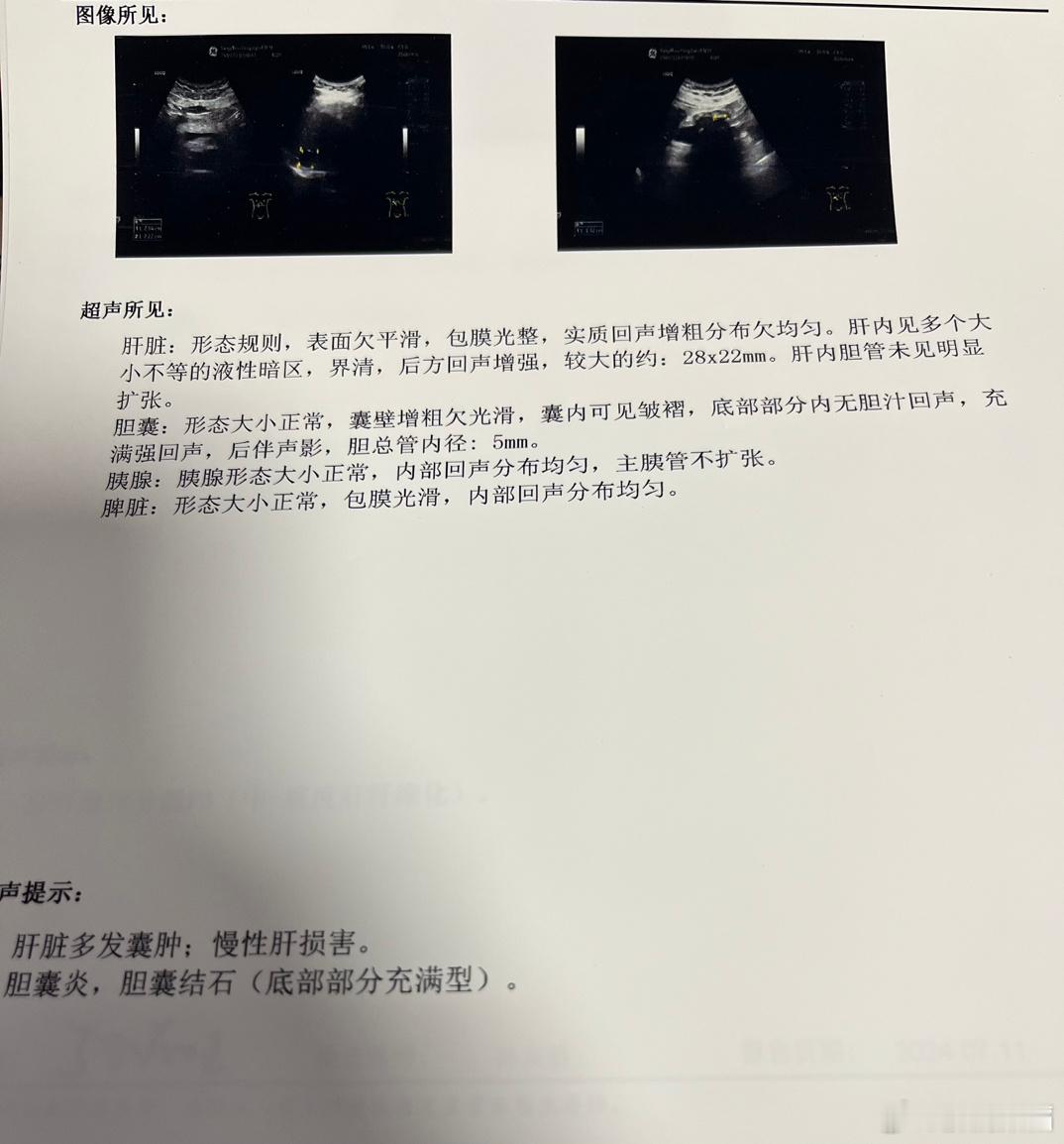 #乙肝[超话]#彩超的主观性很强，而诊断结论也是千差万别，要特别警惕对表面的描述