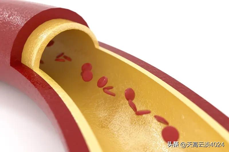 血管堵塞90%，治好有点难，但规范治疗能改善。
治疗方法不少，药物溶栓在急性期用