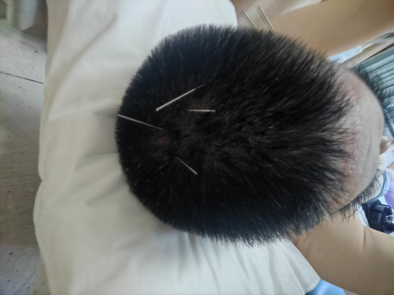 针灸是针法和灸法的总称，包括针刺和艾灸。

      针法是指在中医理论的指导