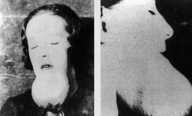 1922年，25岁女工牙疼就医，医生轻碰她牙齿，下颚骨直接碎成粉末，仅4个月她就