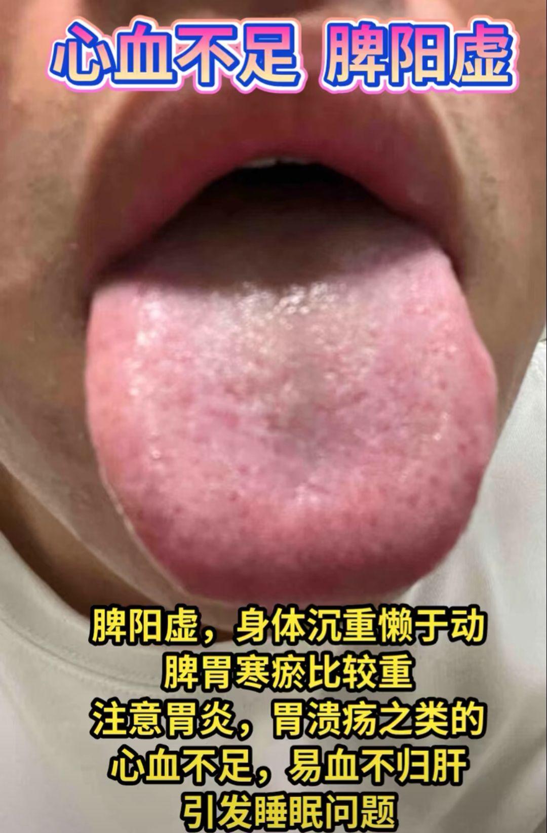 中医舌诊分析，看看你是哪种