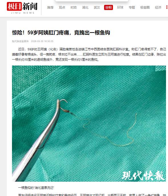 吞下一枚鱼钩，听着就让人头皮发麻。

可这事儿，就真真切切地发生在一位59岁的阿