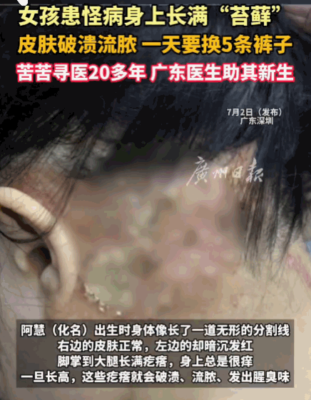 广东，一女子天生“阴阳身”，左边溃烂流脓，右边正常如初。28年来，她被当成怪物，