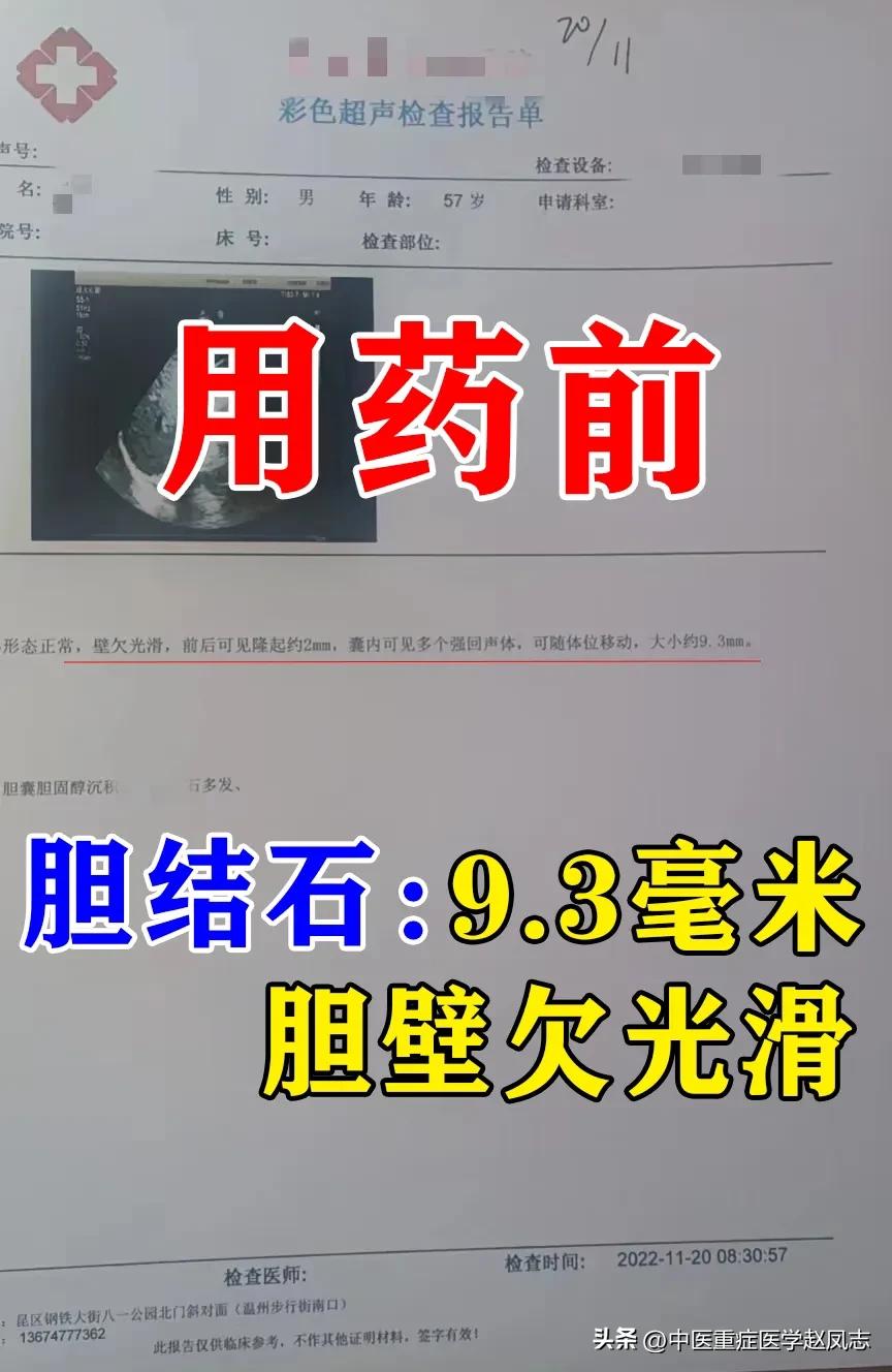 这位患者58岁，男性，胃脘部总是疼痛去检查，发现有胆结石，胆囊壁欠光滑，胆结石9