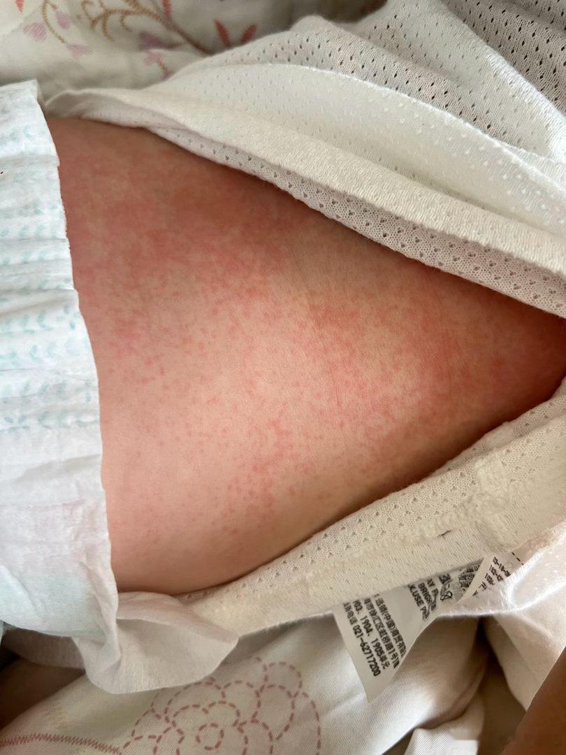 小水晶可能吃了百香果导致过敏了小朋友还是迟一点吃这种吧、也是二胎佛系了+柚柚小时