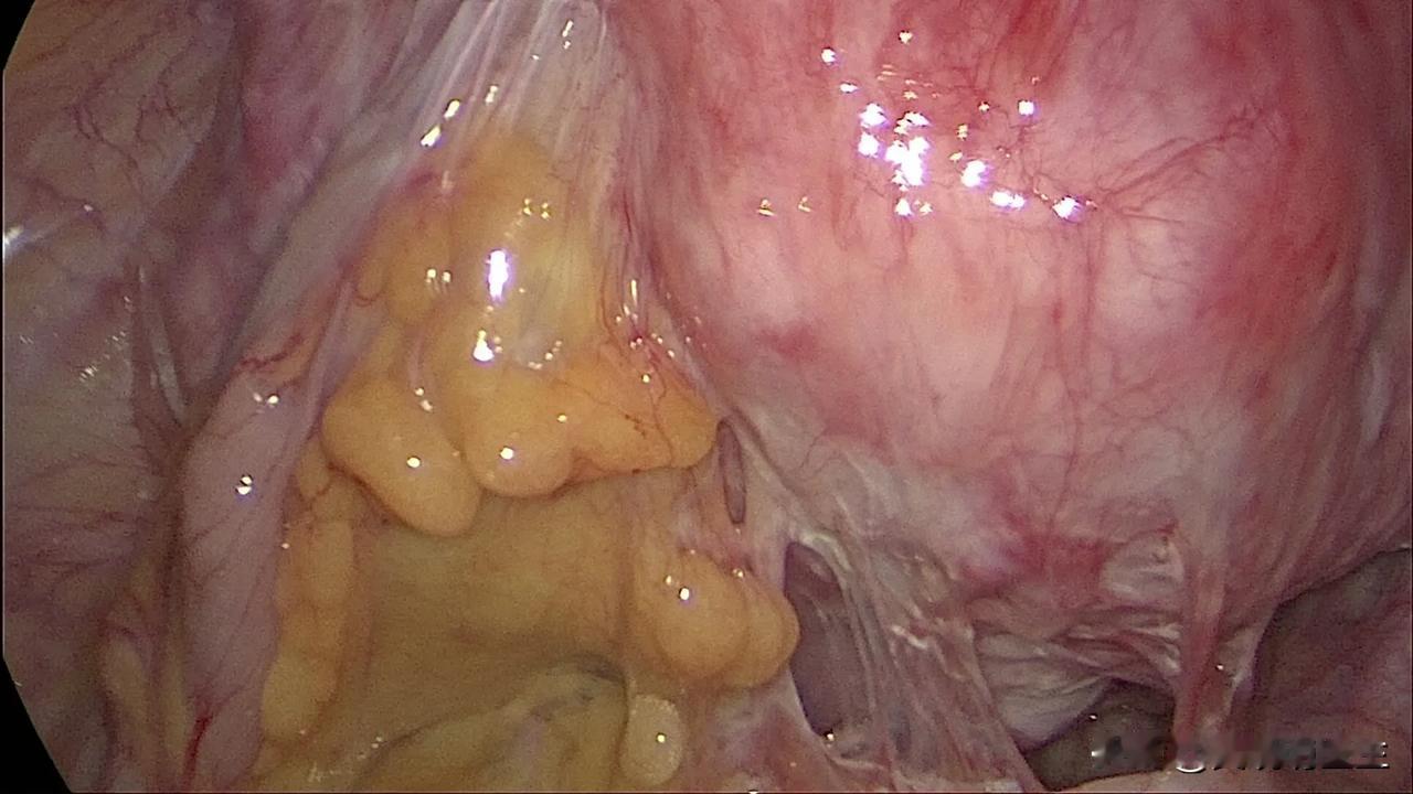 腹腔镜子宫肌瘤剔除或有些地方称之为子宫肌瘤核除这样的手术，虽然是解决子宫肌瘤问题