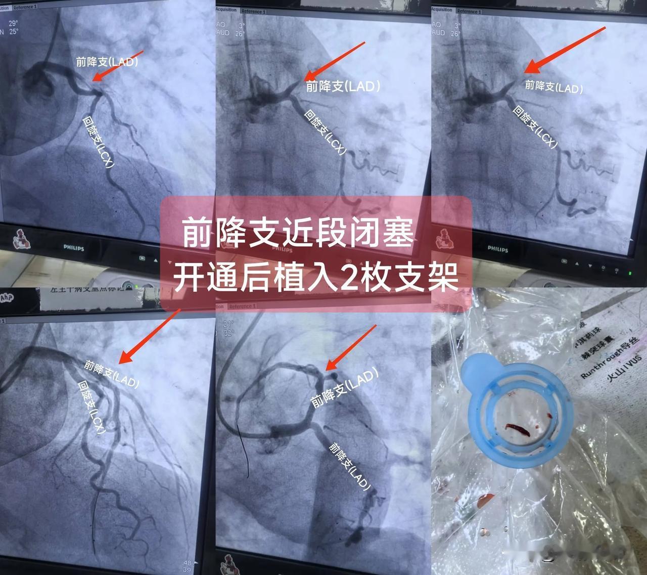 急性ST段抬高型心肌梗死
（前降支近段闭塞)

一.概念：
前降支主要为前壁及前