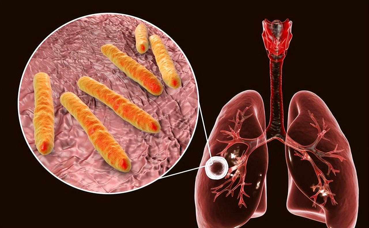 病床上一个病人长了个大空洞，一查发现是少见细菌感染，和生活习惯有关
肺部是一个特
