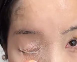 “天塌了！”1月5日，贵州贵阳一女子用502胶水贴指甲片，不慎打翻胶水，眼睛、鼻