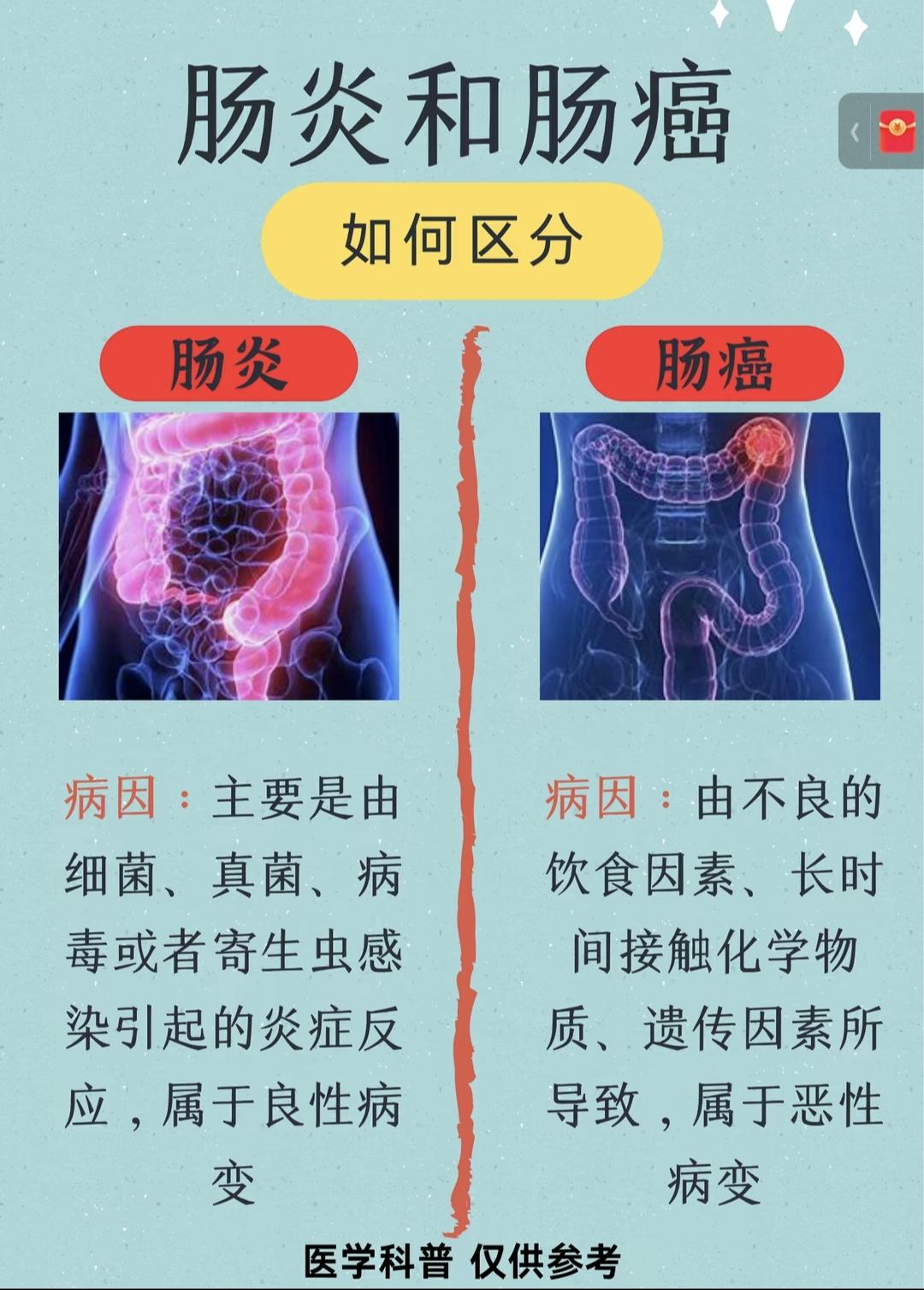 肠炎和肠癌的区别你知道吗？肠癌