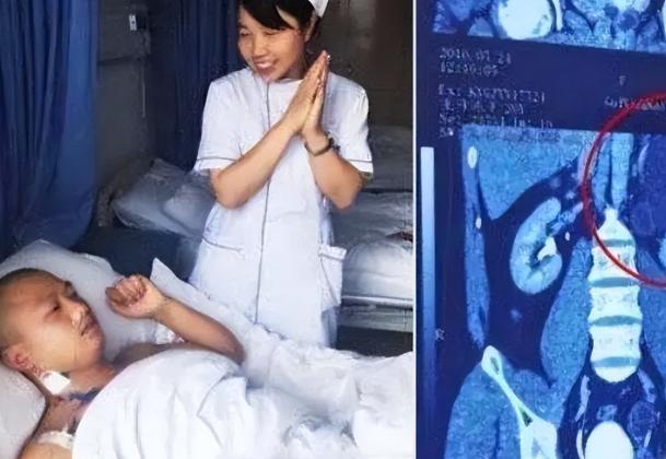 “我的丈夫有4个肾！”2016 年，贵州一名男子因酒量好、精力还特别旺盛。他的妻