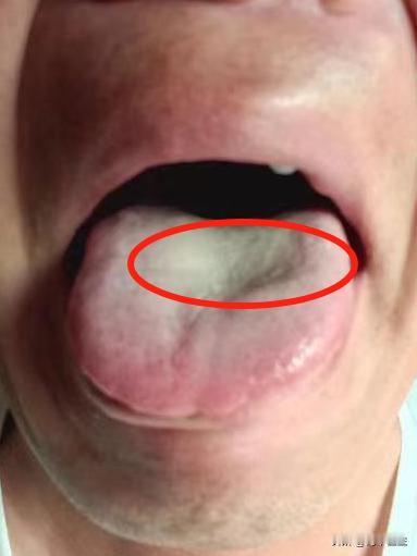 这位男同志，舌根苔都黄这样了，还不上心，这个样子再怎么健脾、补肾，都没用

主诉