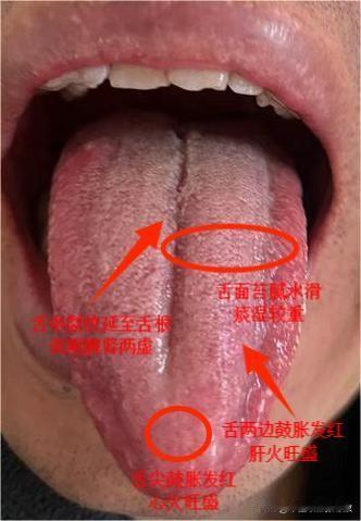 粉丝案例：
张医生，帮我看一下，我老是口腔溃疡，房事还又快又短，苦不堪言！谢谢[
