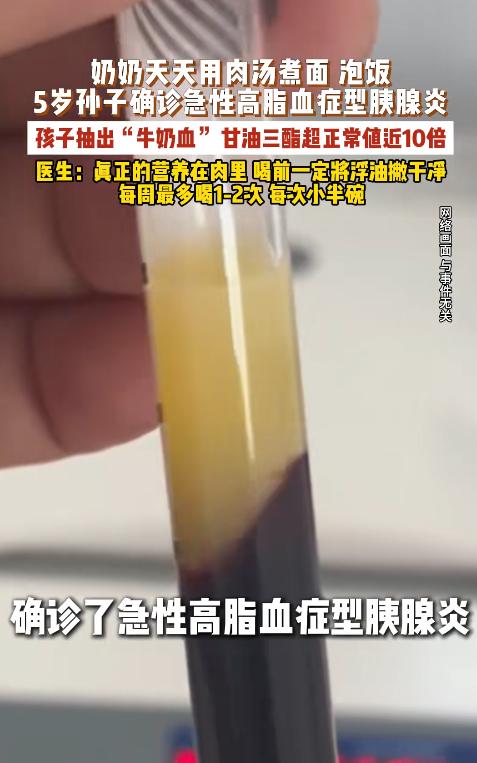 福建一老人为给孙子补营养，几乎每日用浓肉汤煮面泡饭，致孙子剧烈腹痛送医，确诊急性