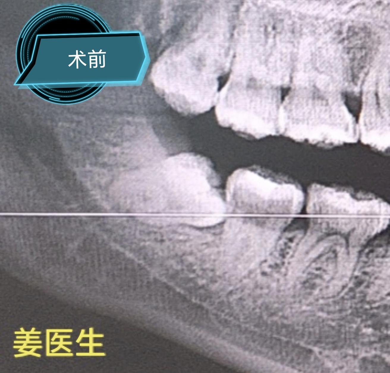 近中高位阻生—拔除步骤