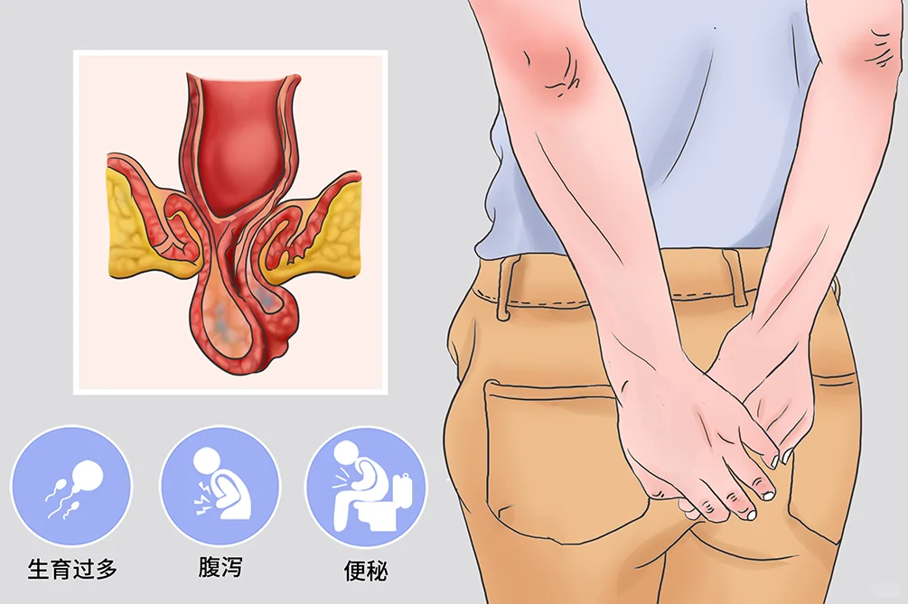 直肠脱垂手术方式优缺点