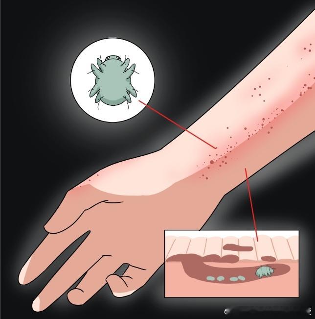 螨虫有很多种，比如我们熟知的尘螨、蠕形螨、疥螨等。尘螨就是在被褥上每天与我们“同