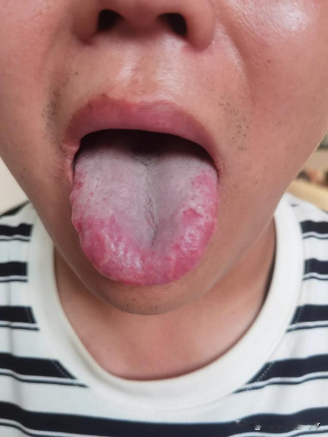 舌尖 发红，偏偏舌中，舌根都是白森森的[狗头][狗头][狗头]
大哥主诉：心烦失