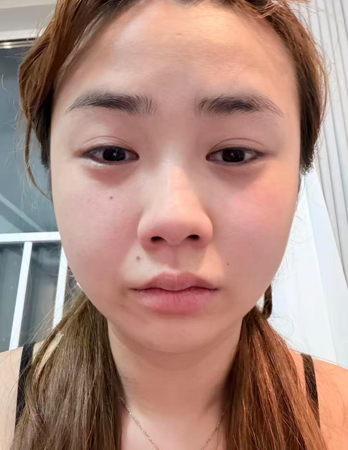 这是董赤赤？为何面容看起来那么的不自然。

知名网红董赤赤身体疑似再出问题，而网