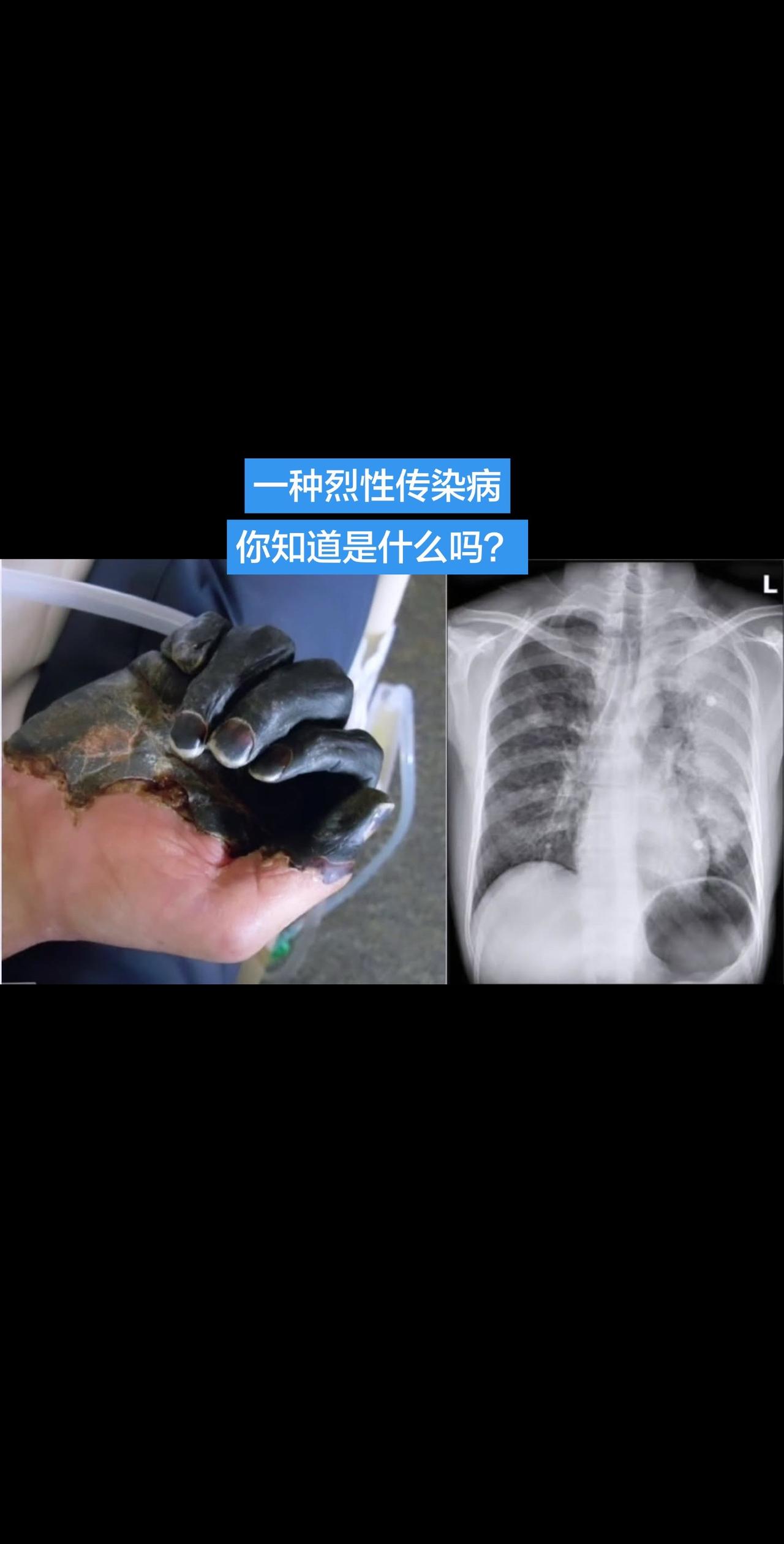 一种让人为之色变的传染病，你知道是什么吗