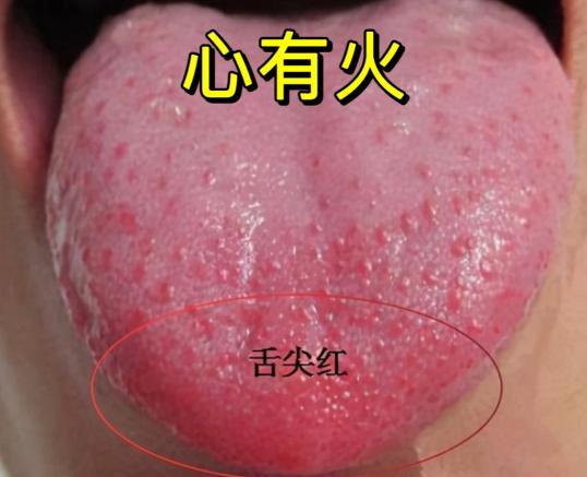 大家好，我是中医陈大夫！生活里不少人总被 “心有火” 困扰 —— 口舌生疮、心烦