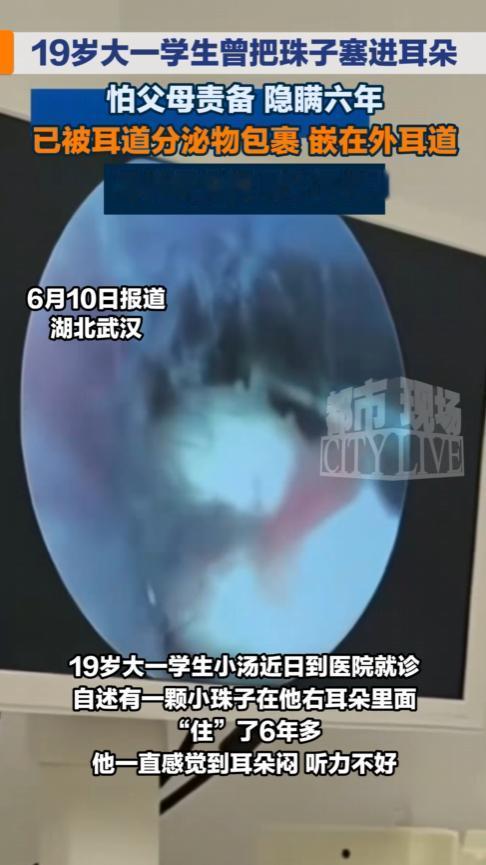6月9日，湖北武汉，一名大一男生在小学时因好奇将一颗小珠子塞进右耳，却怎么都掏不