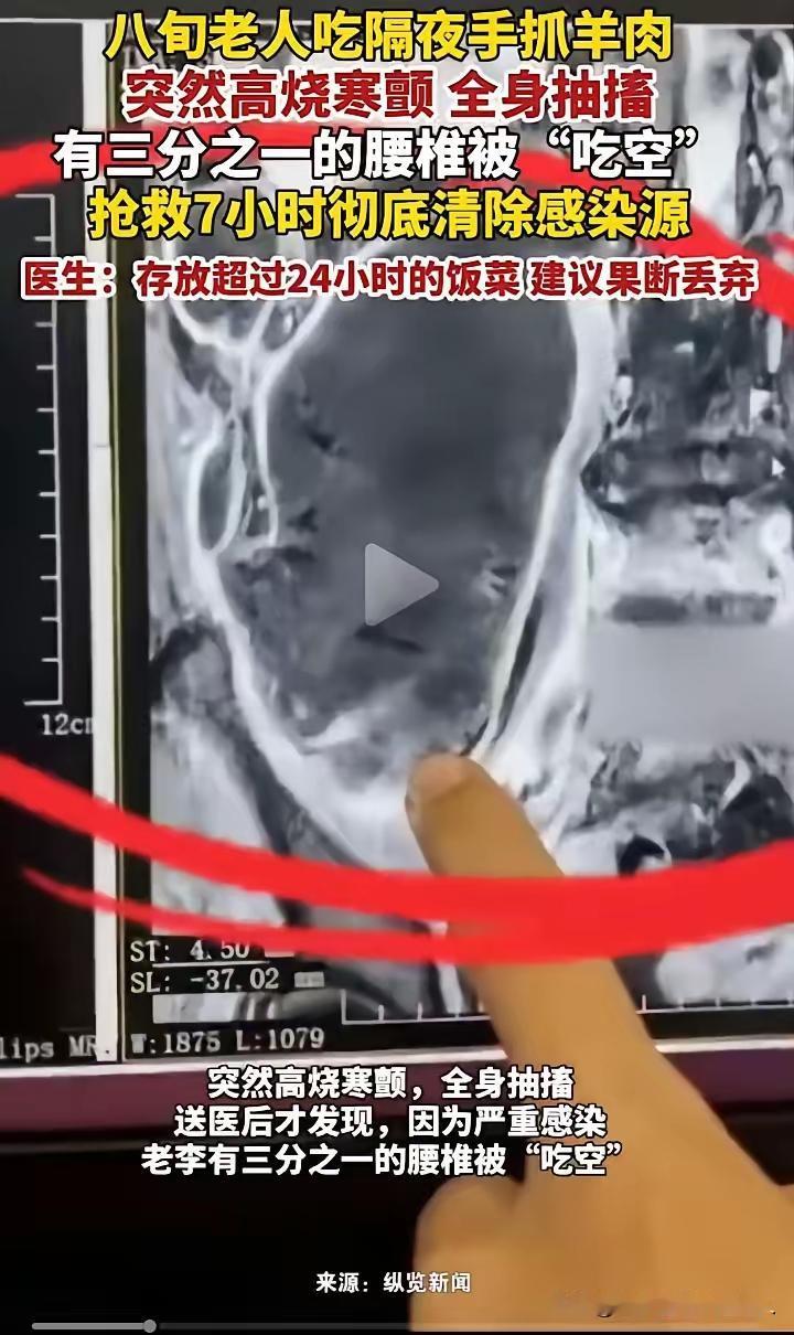 太吓人了！
 
西安82岁老人打包的手抓羊肉放冰箱两天，热过之后吃下去，直接高烧