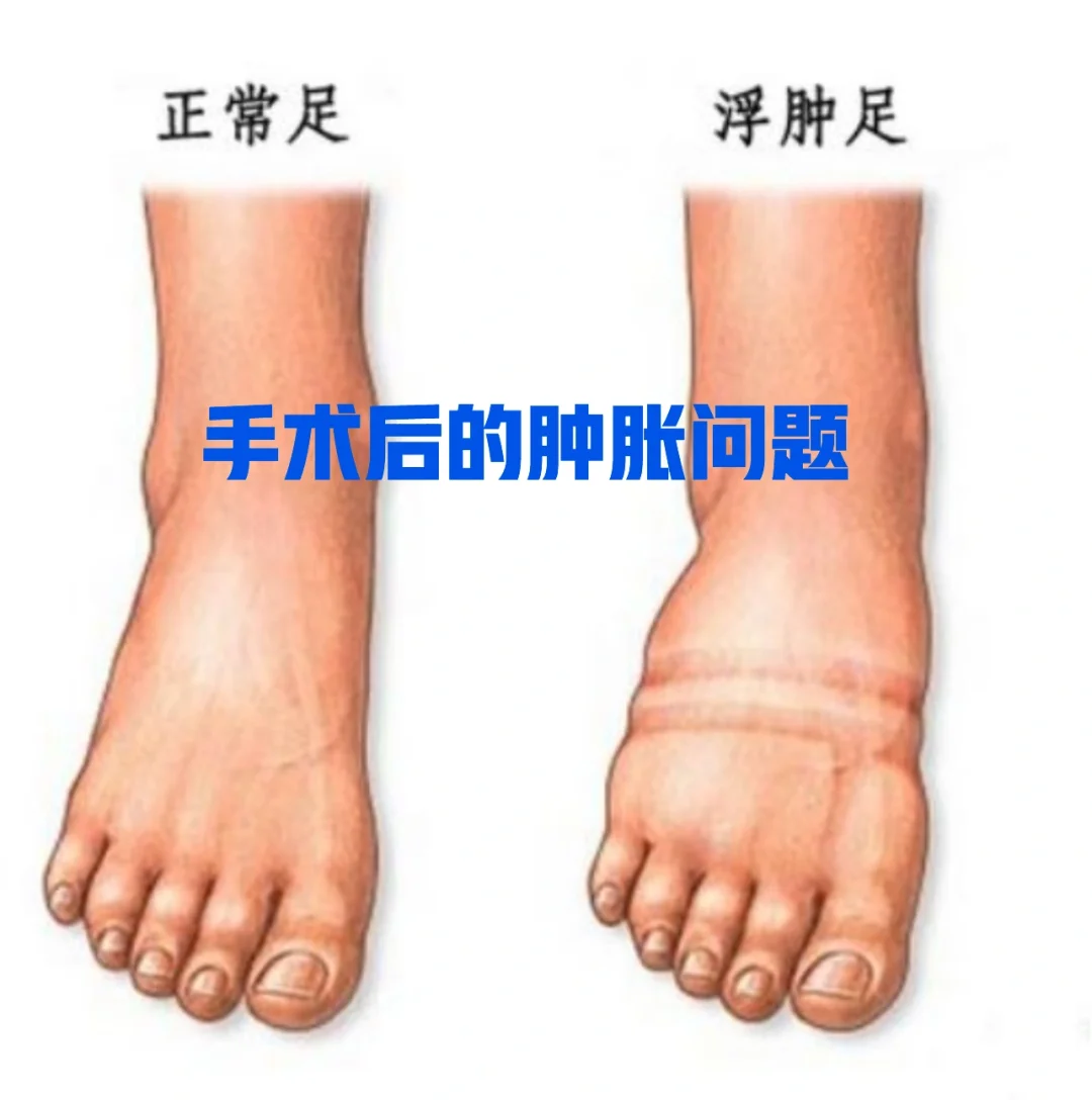 关于拇外翻手术后肿胀问题
