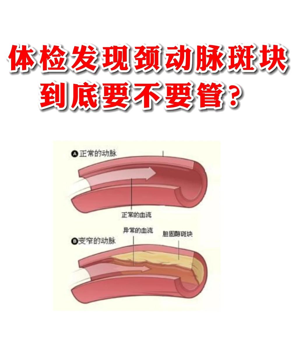 体检发现颈动脉斑块到底要不要管？

大家好，我是中医谢有良医生，在门诊上有个患者