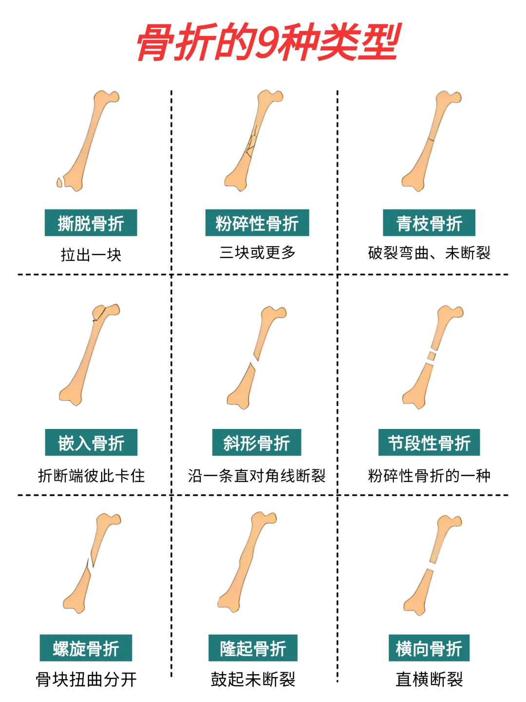 一图看懂骨折的9种类型❗你经历过哪种