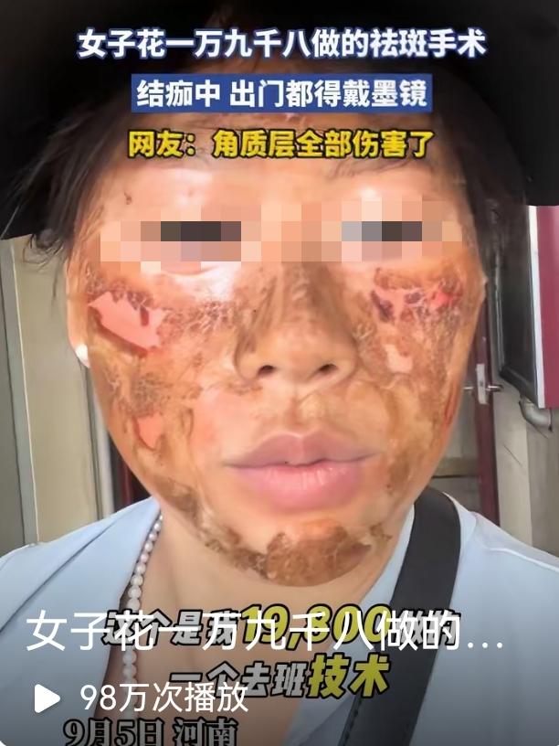 花19800祛斑反毁容！
河南女子脸肿脱皮不带墨镜不敢见人，
这事给所有爱美姐妹