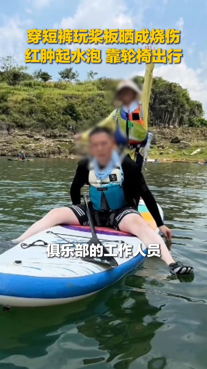 穿短裤玩桨板晒成烧伤，红肿起水泡靠轮椅出行。
李女士。
去贵州兴义的白水河玩的水