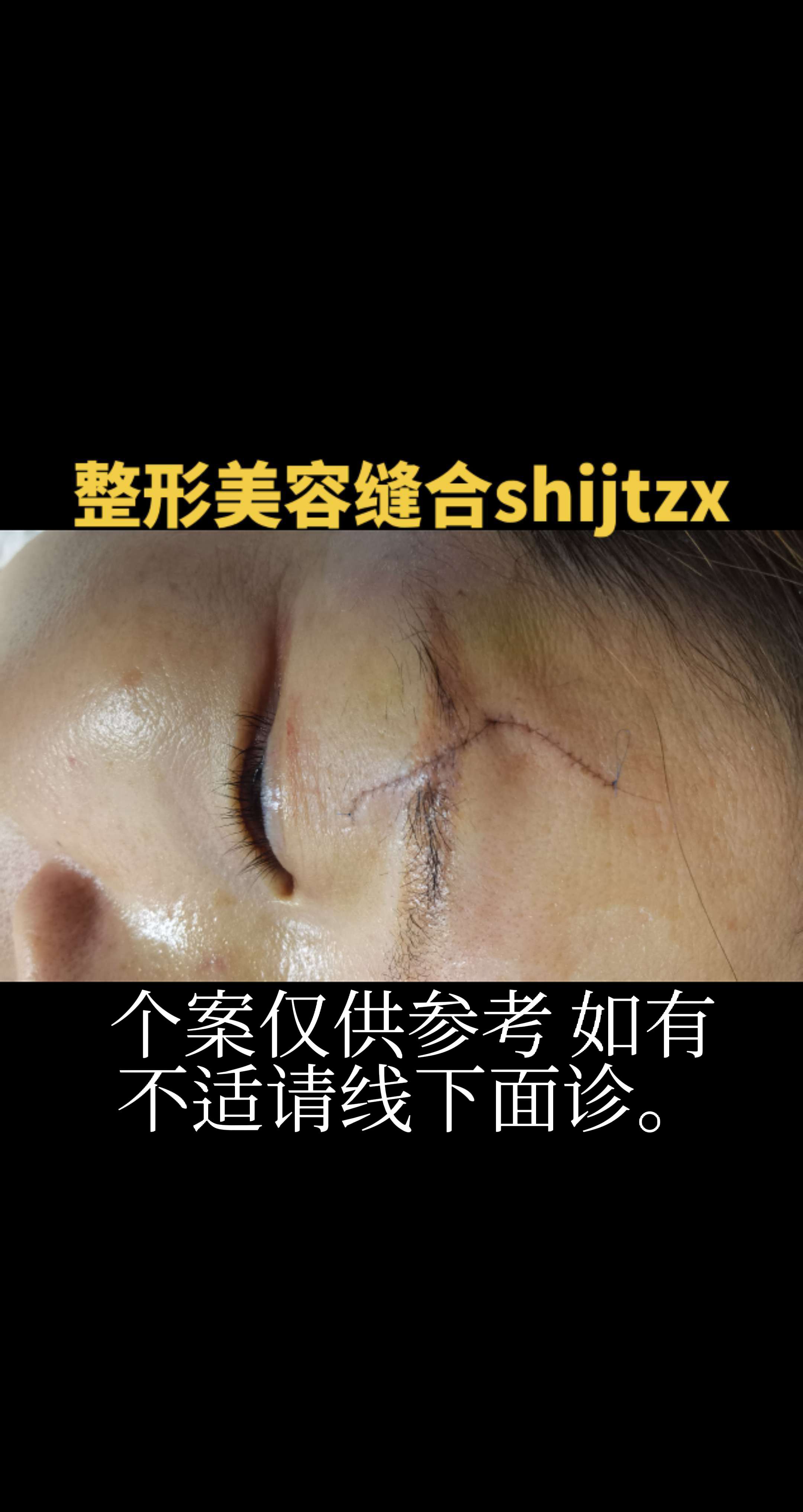 整形美容缝合。台上一分钟台下十年功，整形美容缝合技术是整形外科医生重要...