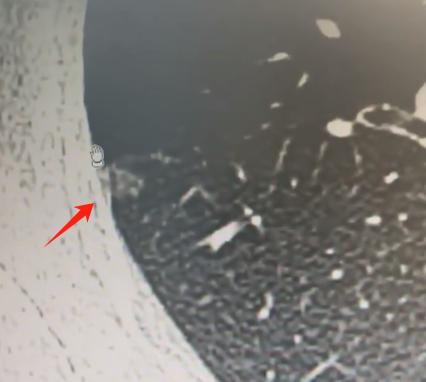 肺原位癌和肺微浸润癌，差别真的很大吗？不少朋友体检发现磨玻璃结节，还带有一些磨玻