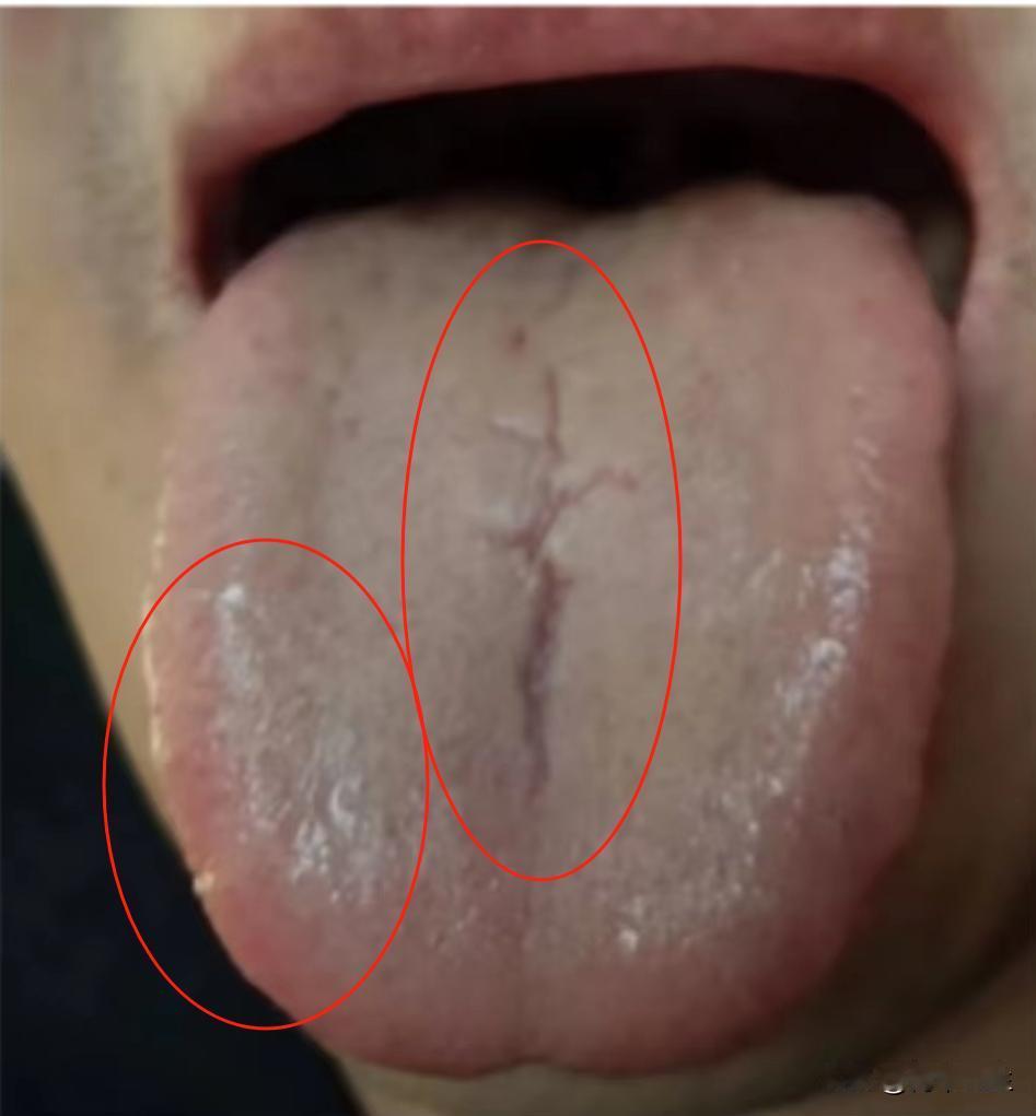 这小伙子还真能忍，裂纹都快从头到尾了，还觉得问题不大，真不知道要虚到什么程度才能