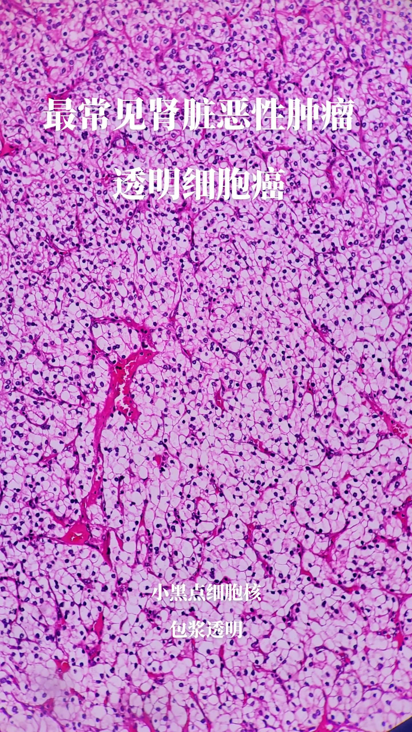 显微镜下的世界 
肾脏透明细胞癌