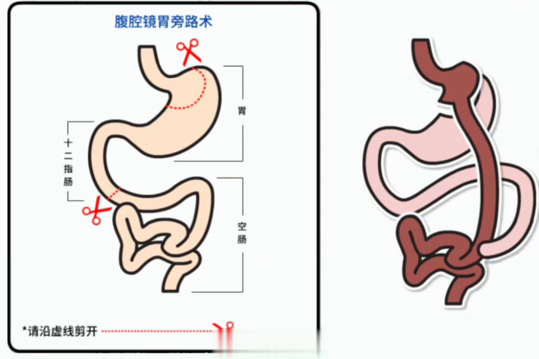 #女子做手术1年暴瘦70斤成九级伤残#减重手术，现在临床上很流行，因为是腹腔镜，