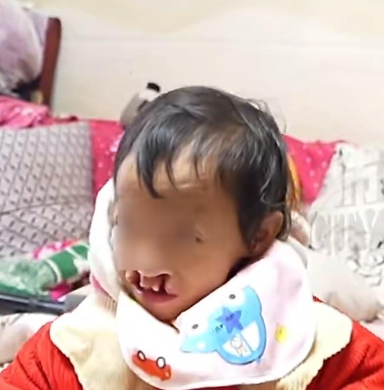 这个兔唇小孩算很严重的了！

如今六岁了，家里还没带她去做手术。网友偶遇发文求助
