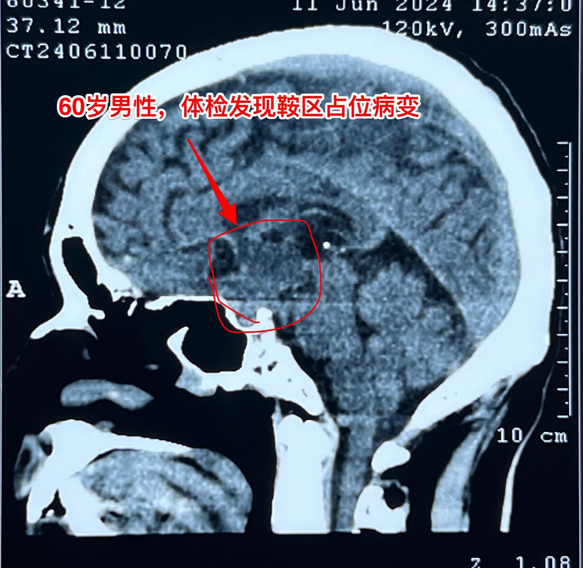 颅咽管瘤与拉克氏囊肿的鉴别不容易。60岁男性，偶然因头痛作体检发现鞍区...