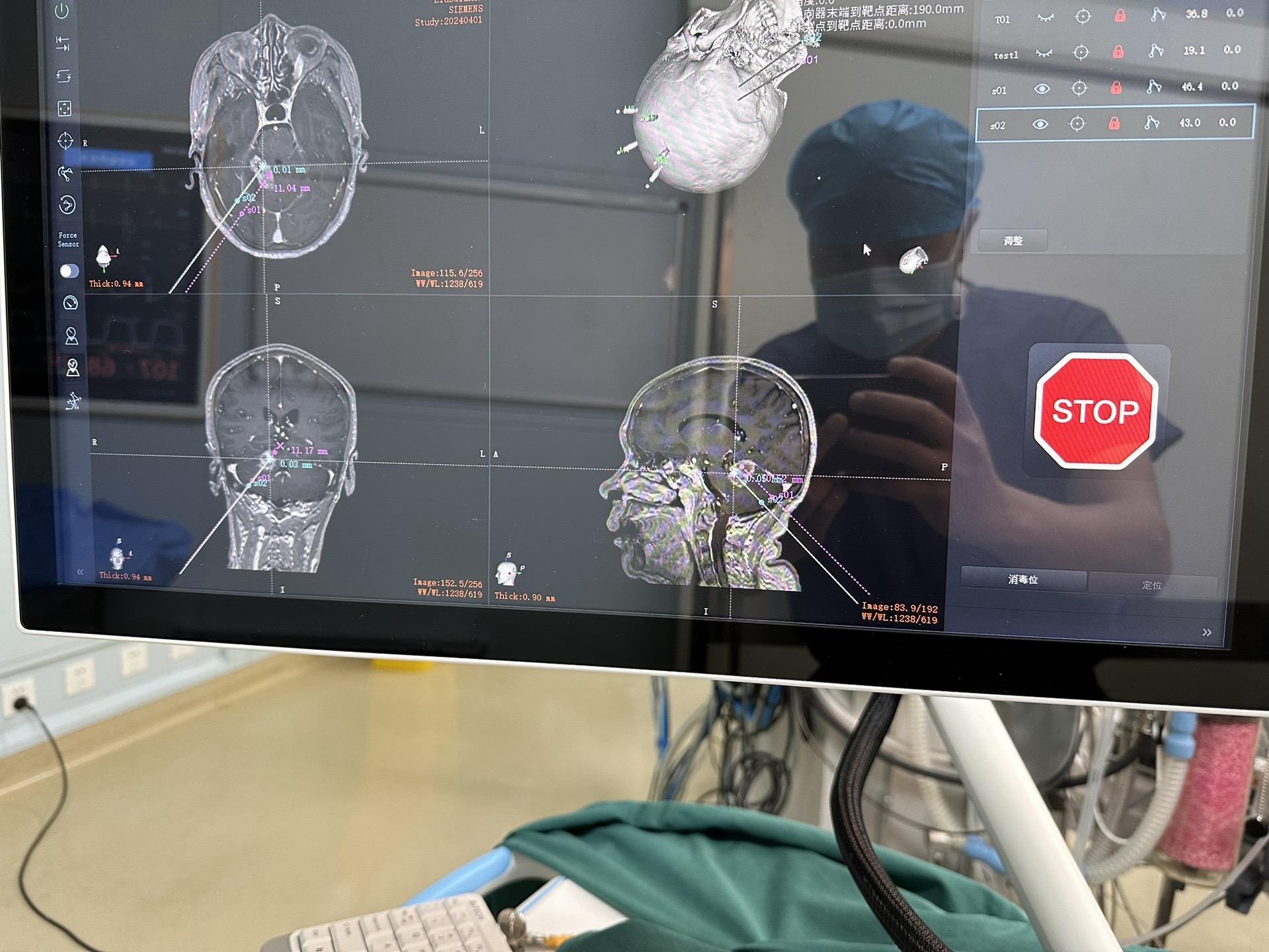 高温“烧死”肿瘤。利用机器人植入光纤，磁共振引导下高温消融颅内恶性肿瘤，看起来像科幻片，需要大量人力和高端设备加持！