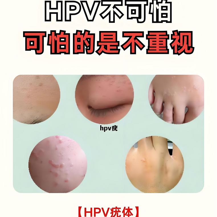不论男女，身上长出这5种“瘊子”，或已感染HPV病毒！请不要轻视

李阿姨不喜欢