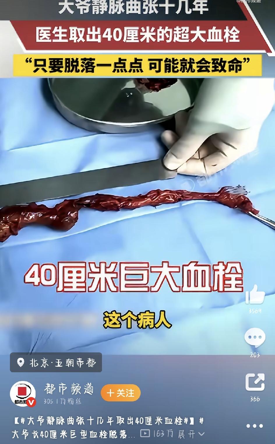 忽视十几年的静脉曲张，大爷腿里竟藏了条40厘米长的“要命血栓”
在很多老北京人眼