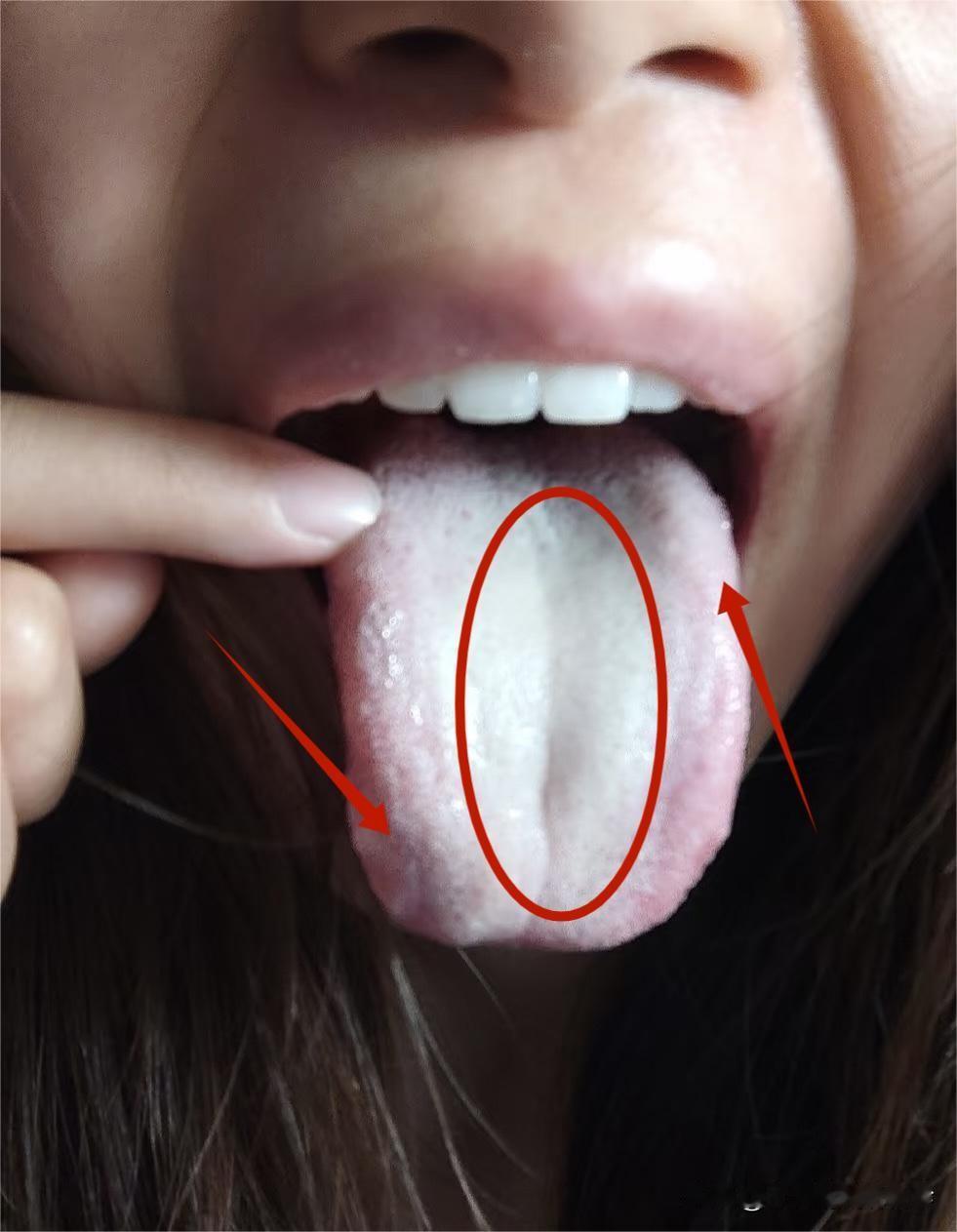 像这种阳虚、寒湿重的舌象？千万不要一上来就补，疏通肝气才是关键！

患者主诉：畏