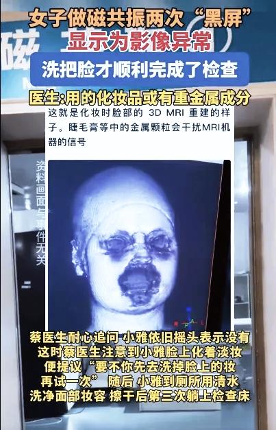 福建29岁女子小雅因头晕做头颅磁共

振，连续两次扫描均因面部成像异常中

断。