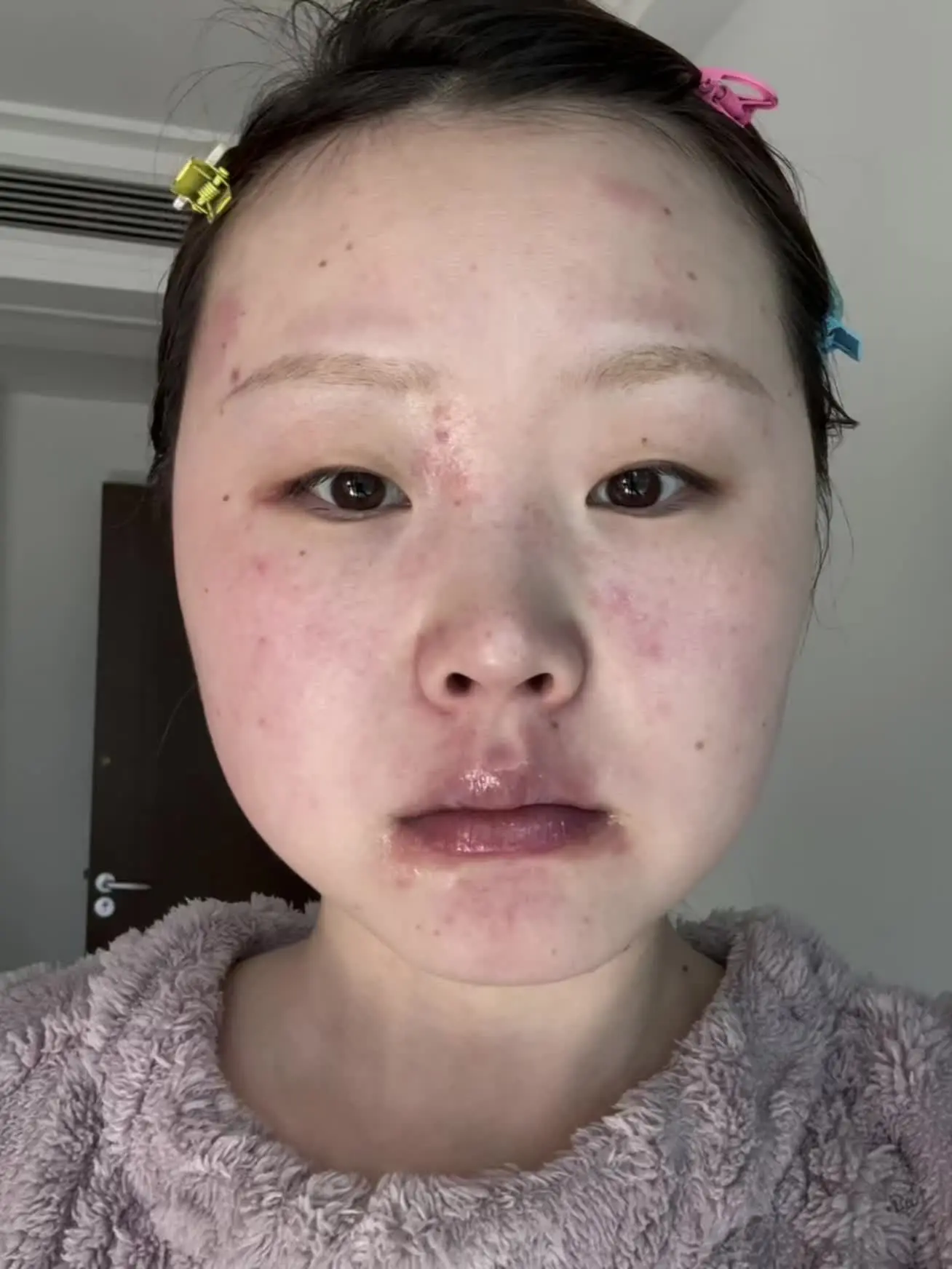 最近和过敏作斗争中