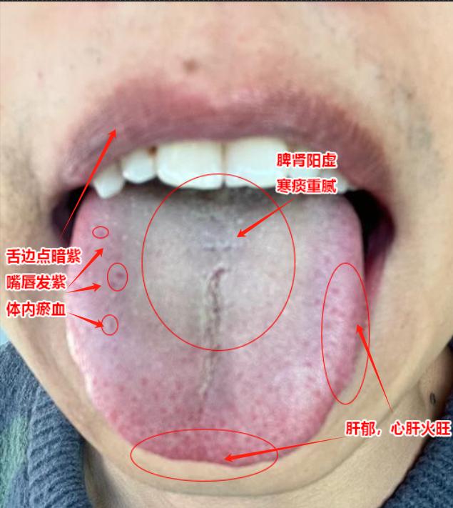 这种舌象，疏肝健脾补阳，你以为全面考虑了？只要看不到这点，就是白瞎干！

自述：