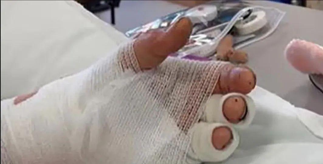 瑞士一名25岁工人跌入720℃铝液熔炉，忍痛将自己拉出炉子，奇迹幸存。


皮特